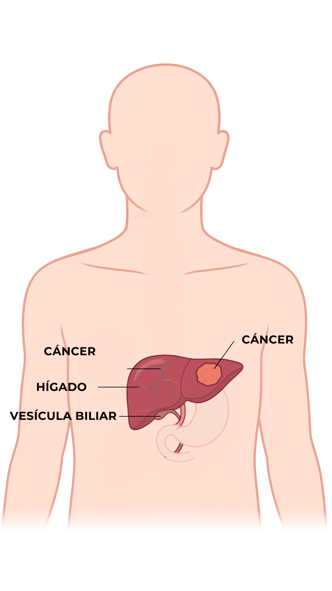 Anatomía - Cáncer de Hígado
