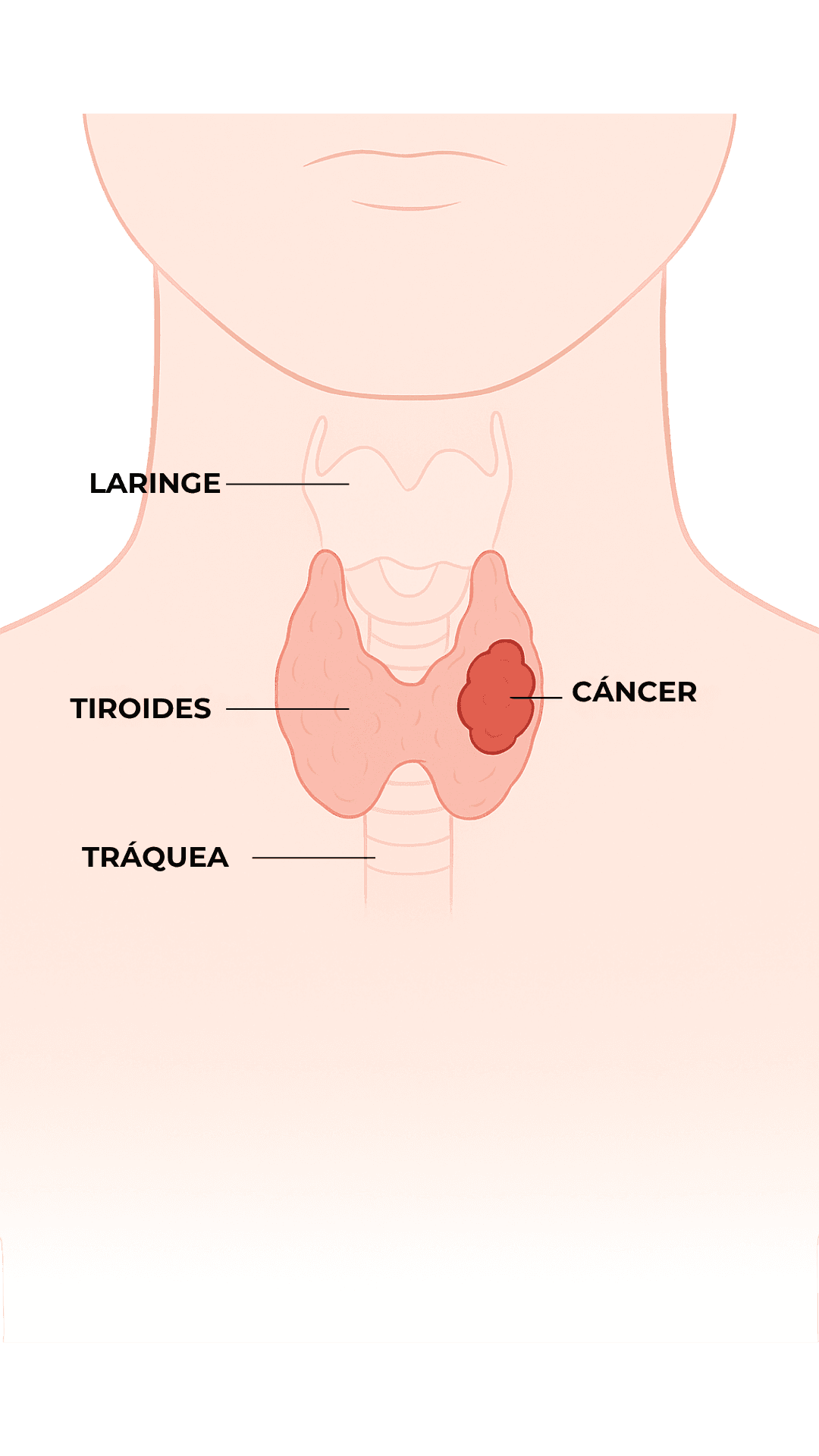Anatomía - Cáncer de Tiroides