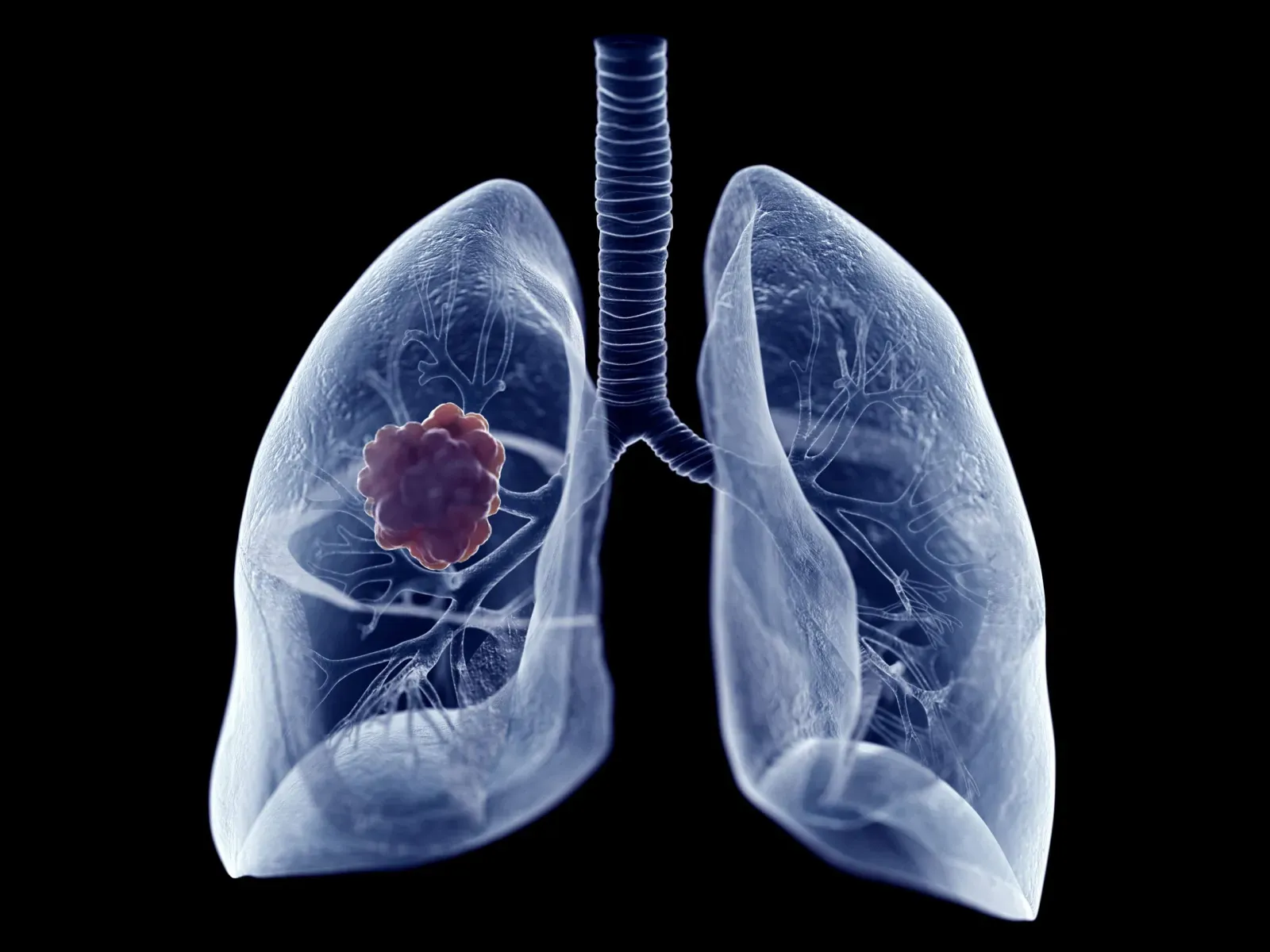 Cáncer de pulmón: ¿Siempre conviene el tratamiento más agresivo? Masa tumoral en pulmon