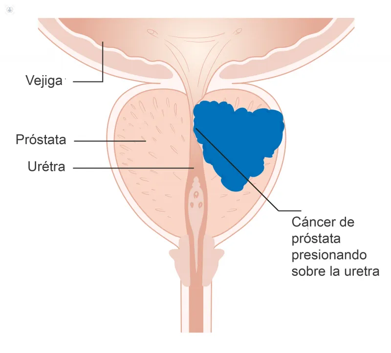 Cáncer de próstata: cómo enfrentar los efectos secundarios de la terapia hormonal Cancer de Prostata