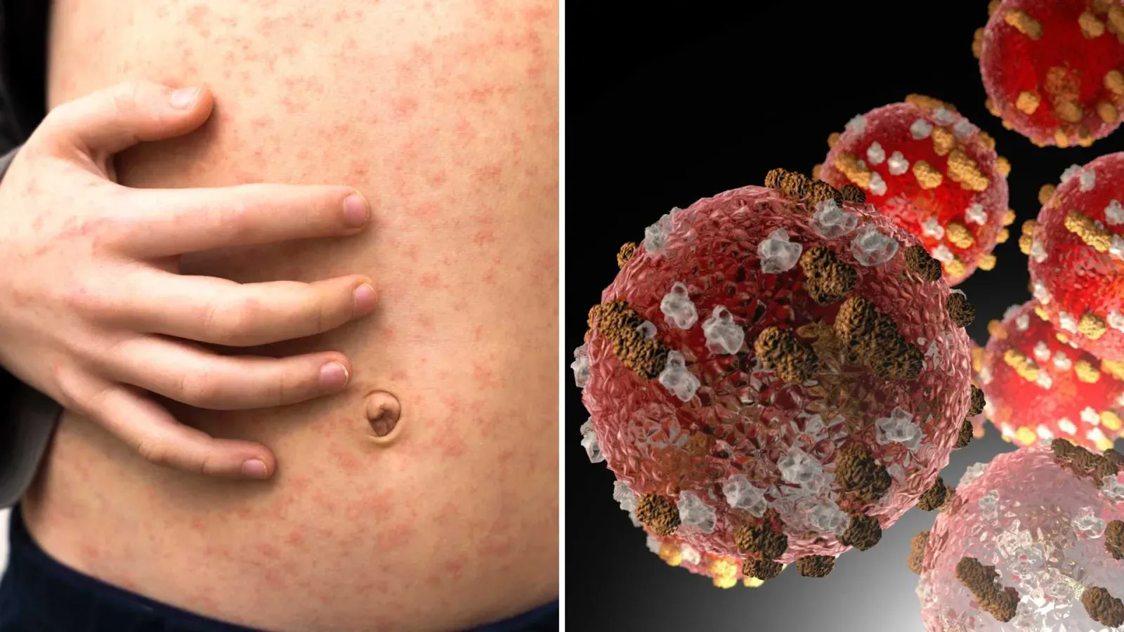 Sarampión y Cáncer