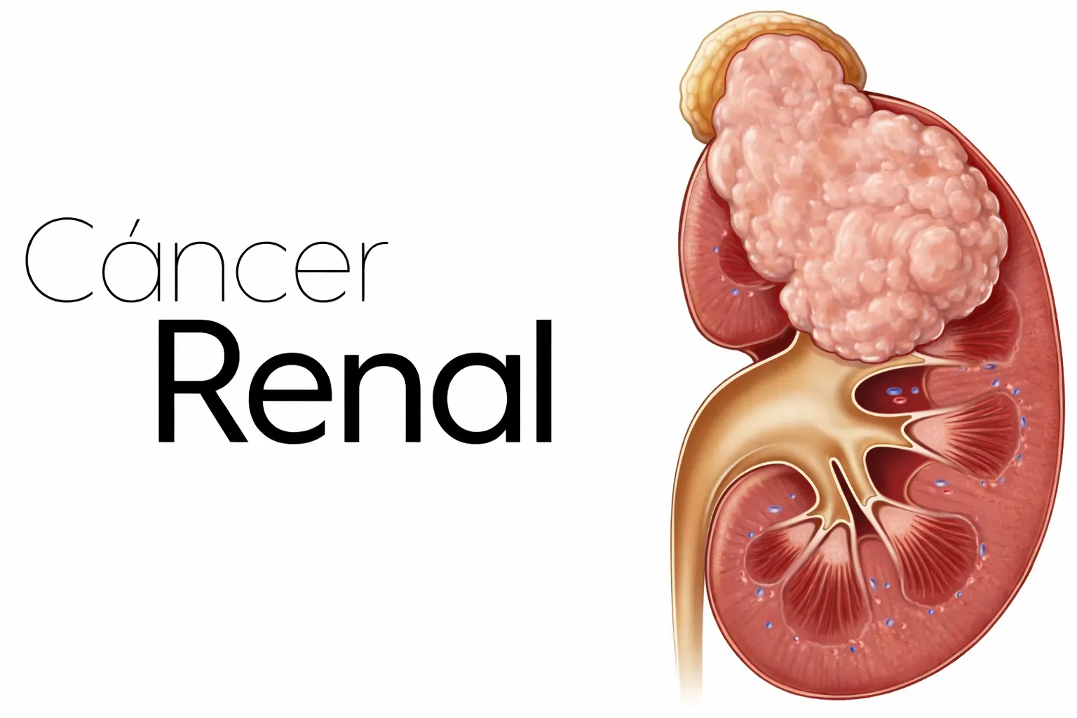 Cancer Renal