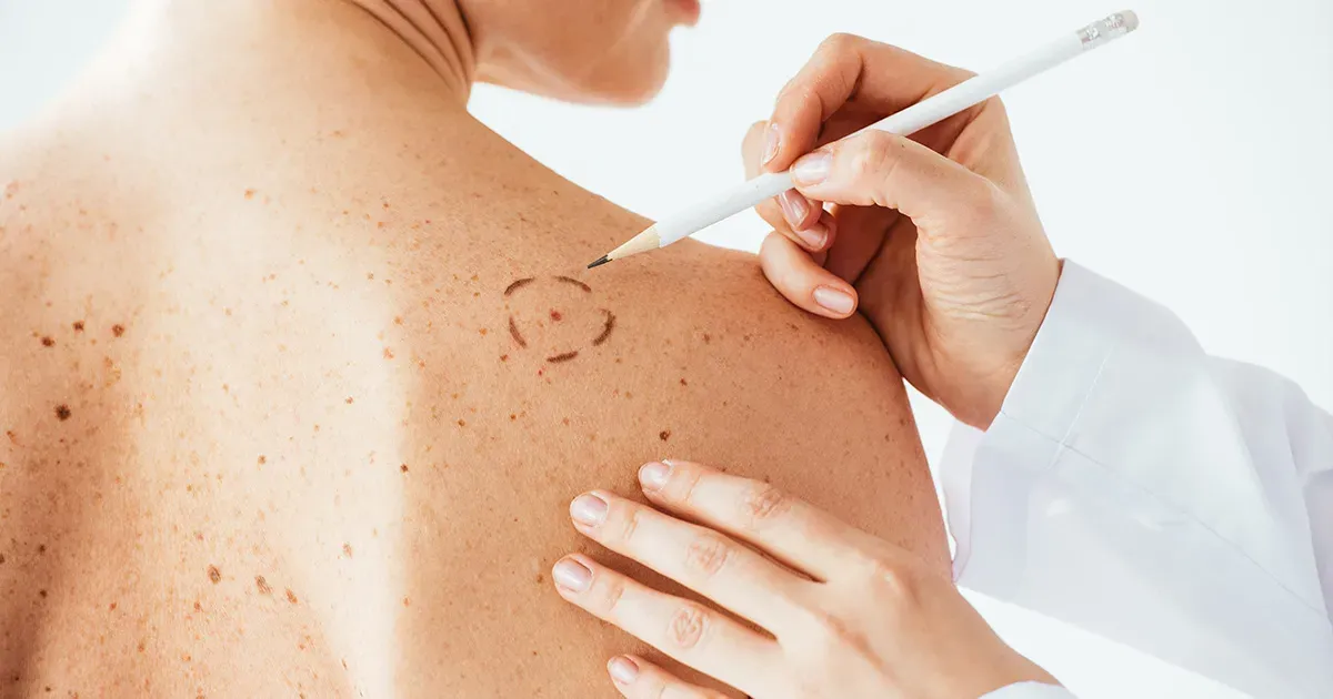 Prevención del melanoma .