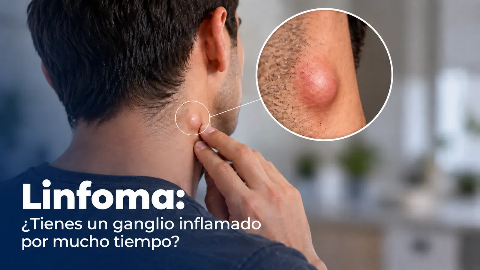 Linfoma: ¿Tienes un ganglio inflamado por mucho tiempo? hombre con ganglio inflamado