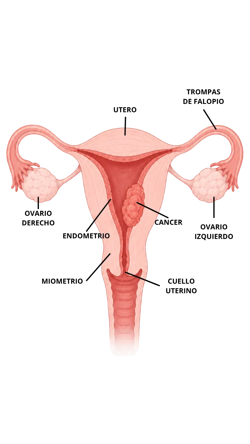 Cáncer de endometrio