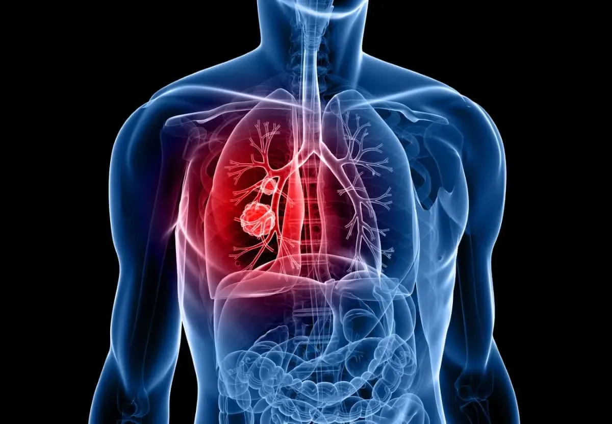cancer de pulmon