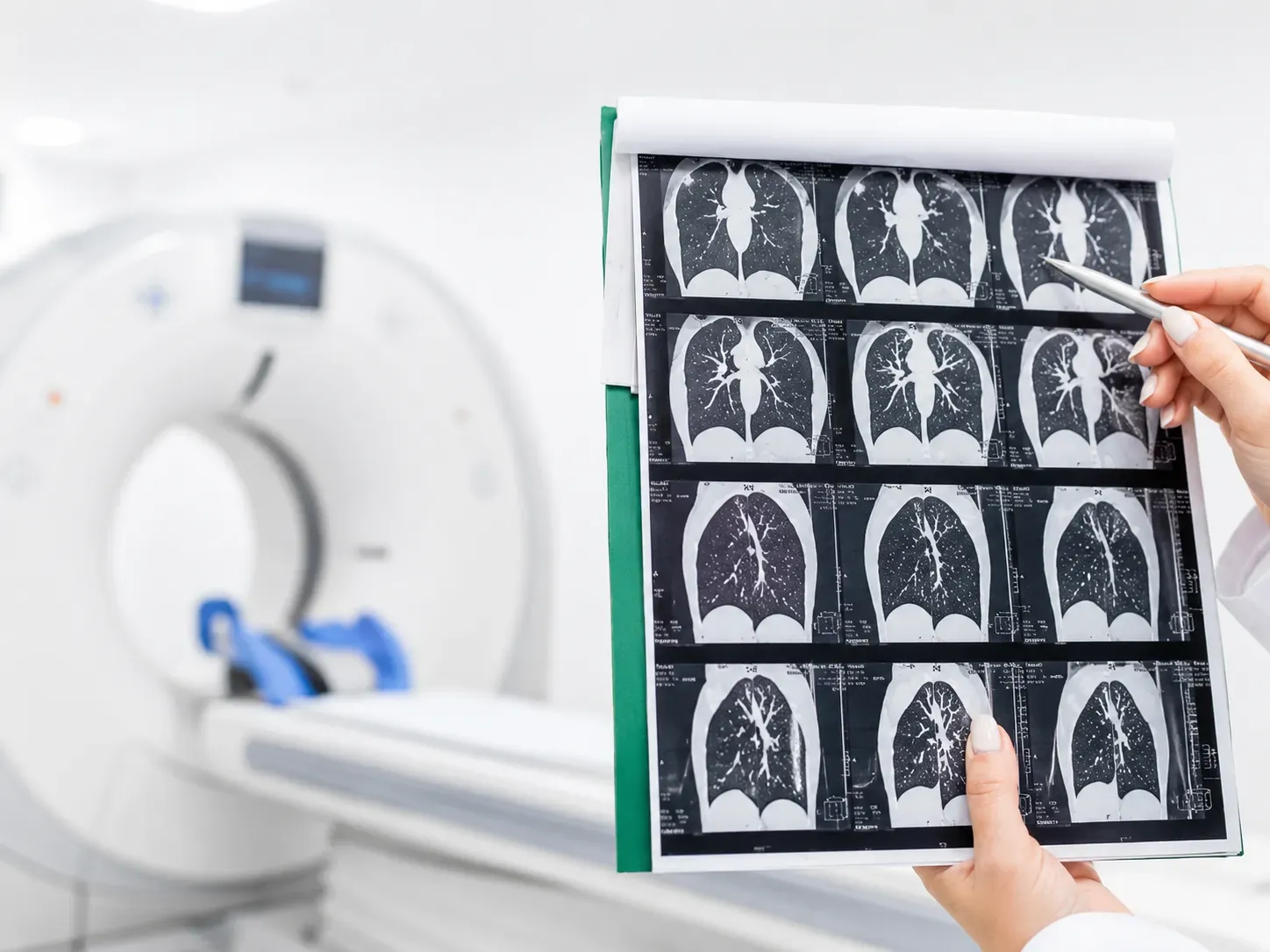 Cáncer de pulmón: conocer las mutaciones del tumor puede cambiar el pronóstico de cada paciente Mutación EGFR