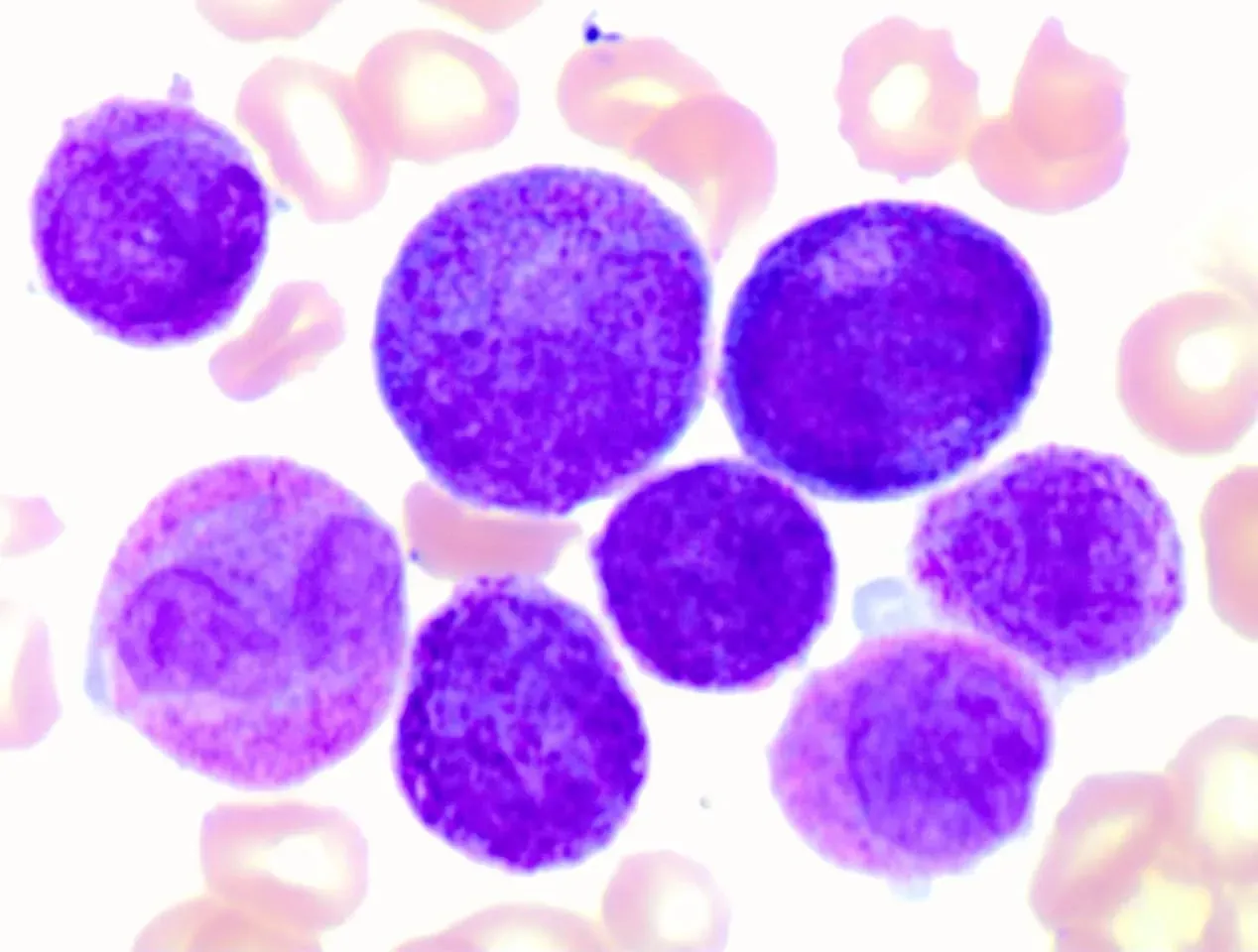 El medicamento que transformó una leucemia mortal en una enfermedad curable Leucemia Promielocitica