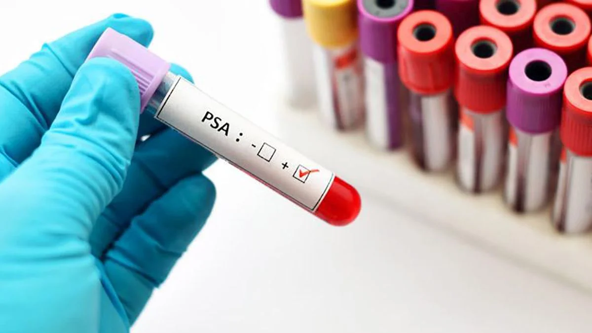 Cancer de Prostata