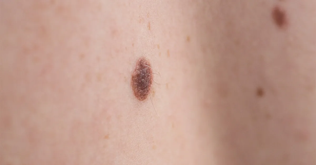 Melanoma .