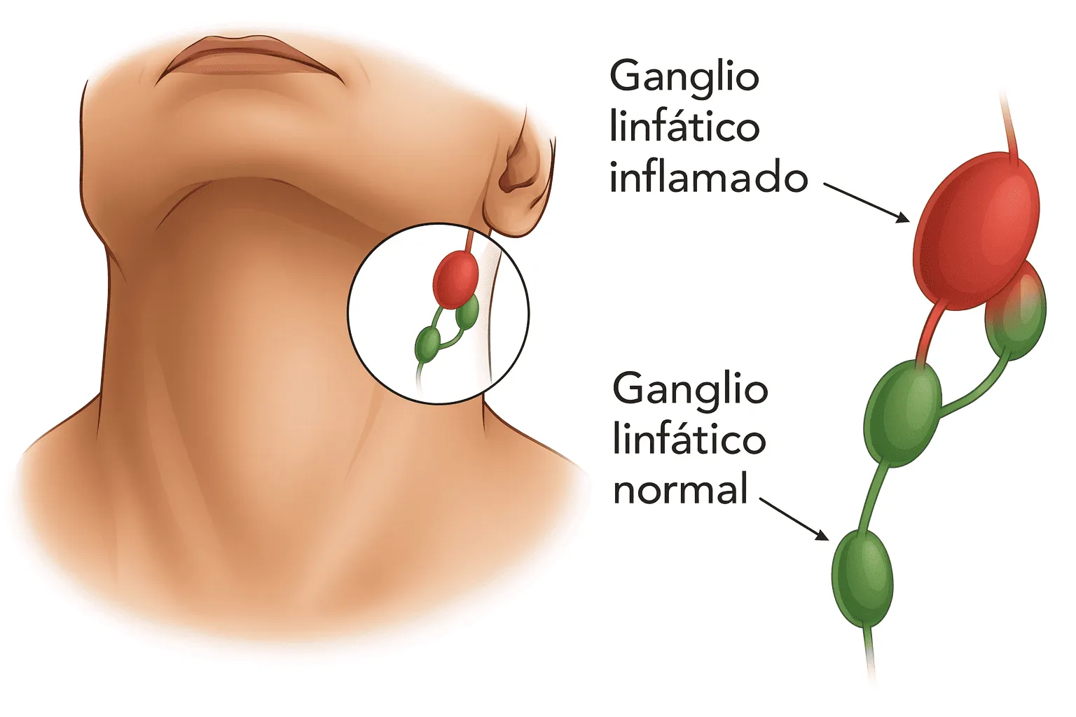 Los ganglios inflamados: ¿siempre son cáncer?