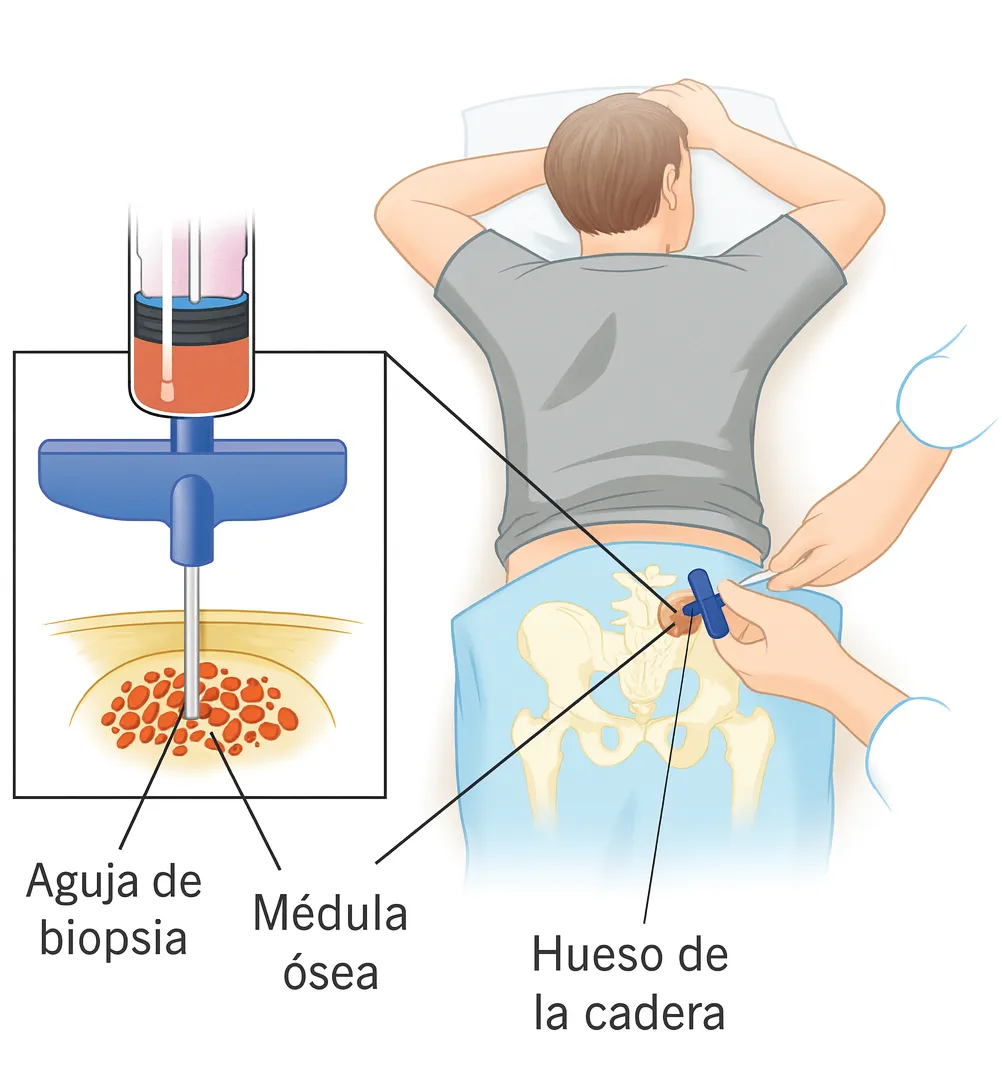 Aspirado de médula ósea: qué es, cómo se realiza y por qué es importante