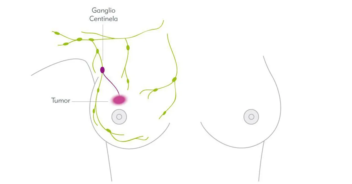 Ganglio Centinela