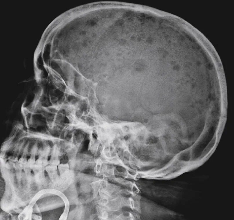 Carfilzomib: nuevo tratamiento para el Mieloma múltiple