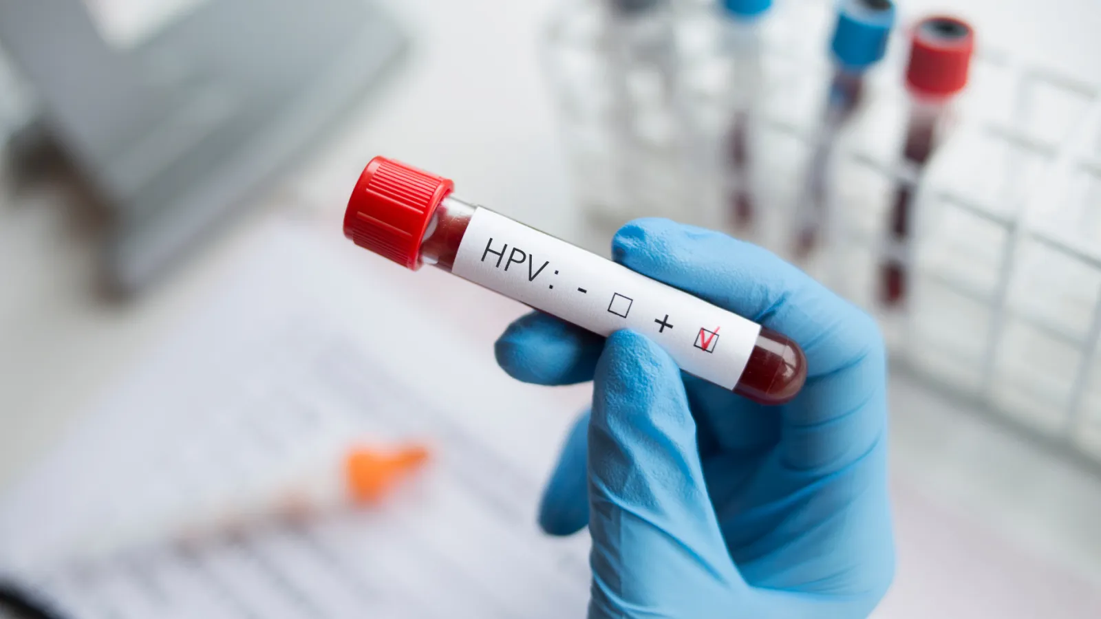 Prueba de VPH: el examen de laboratorio que puede detectar riesgo antes de que exista cáncer
