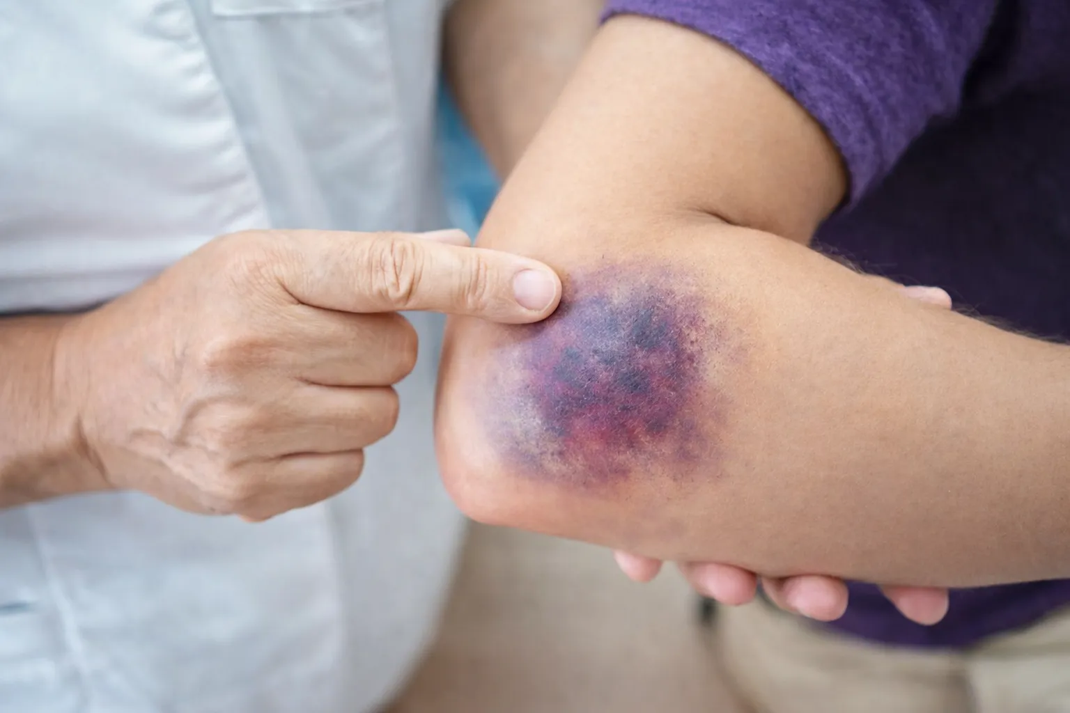 Moretones frecuentes o sangrados: ¿cuándo preocuparse?