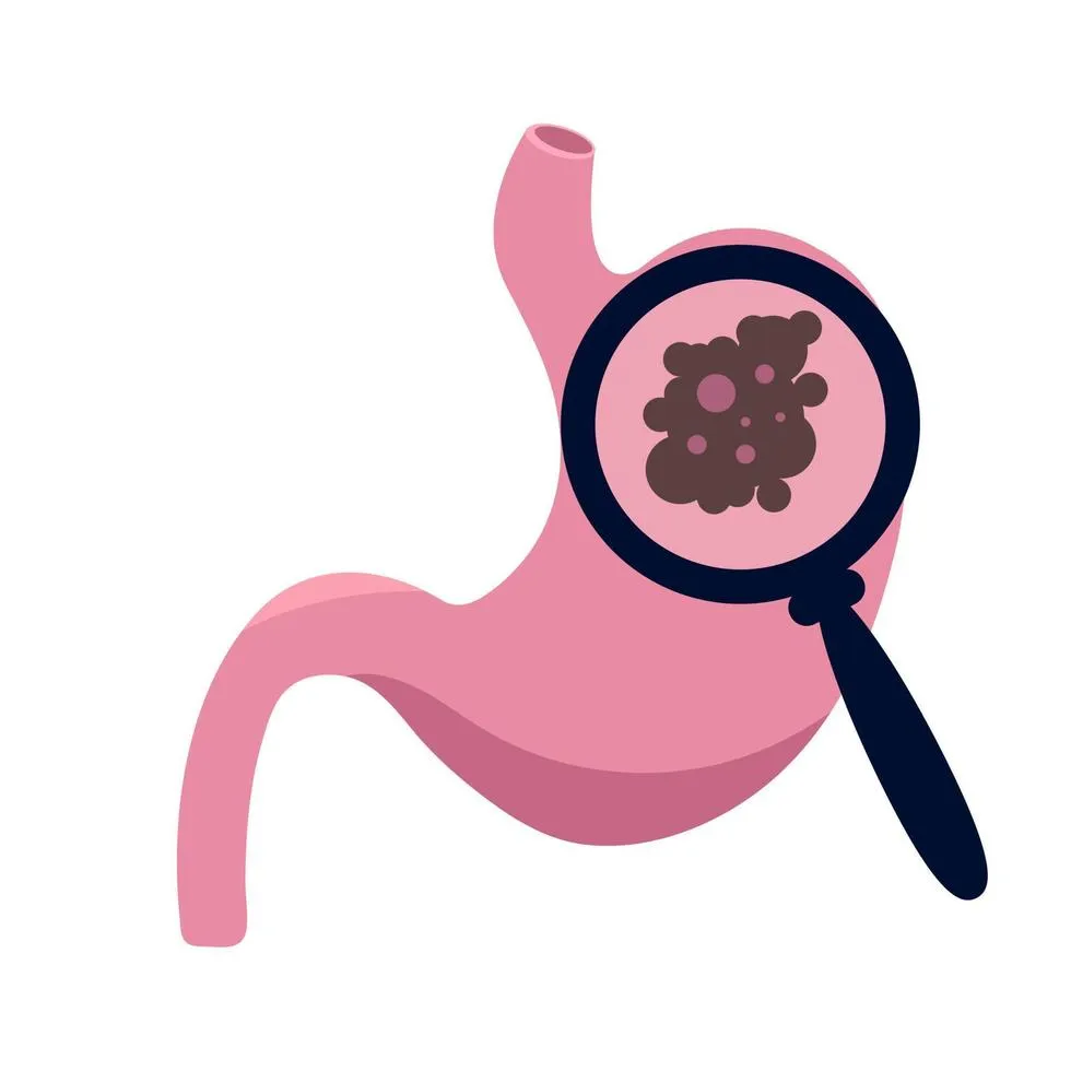 Cáncer de Estomago Cáncer de Estomago