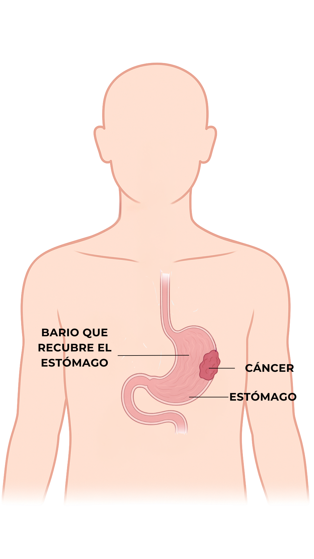 Anatomía - Cáncer de Estómago